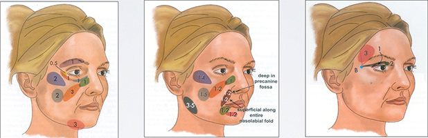 Facial-lipofilling-technique